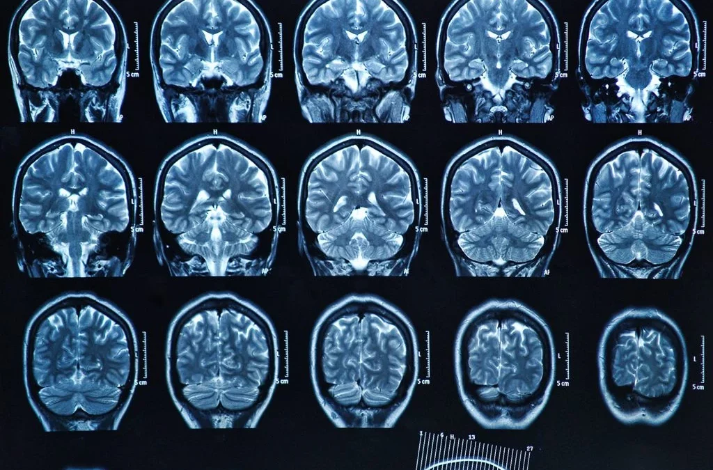 Understanding Acute Ischemic Strokes