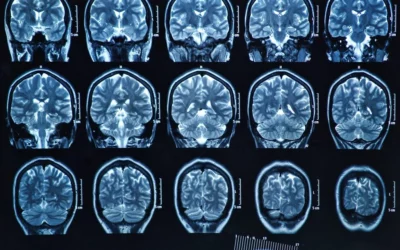 Understanding Acute Ischemic Strokes
