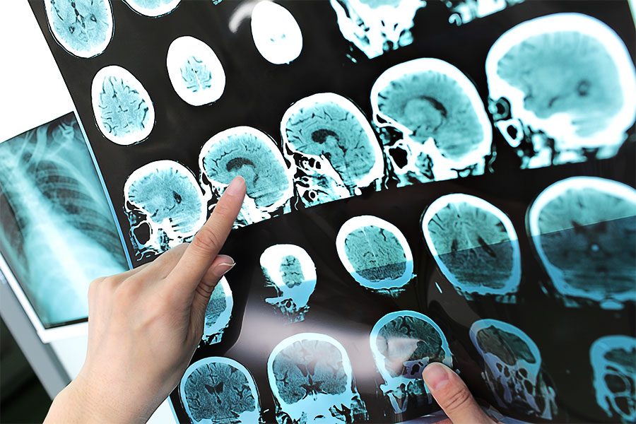 Stroke Misdiagnosis