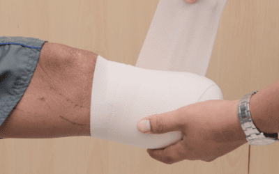 Amputation Injuries: When a Preventable Mistake Leads to Permanent Loss