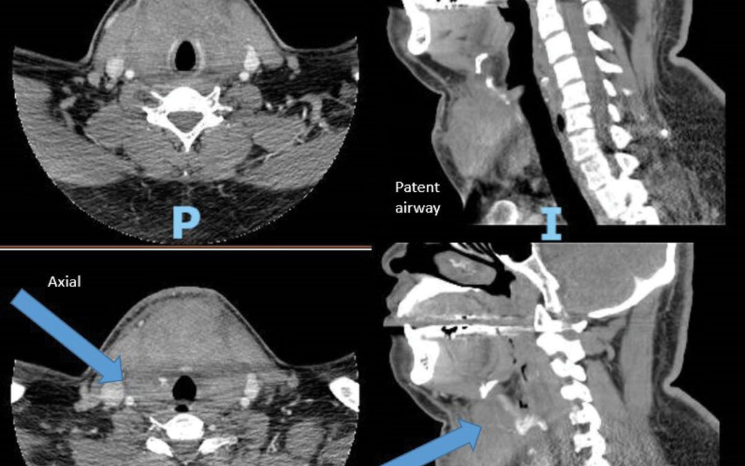 When a Neck Hematoma Becomes a Medical Emergency