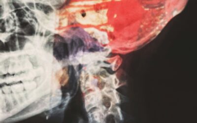 When a Neck Hematoma Becomes a Medical Emergency